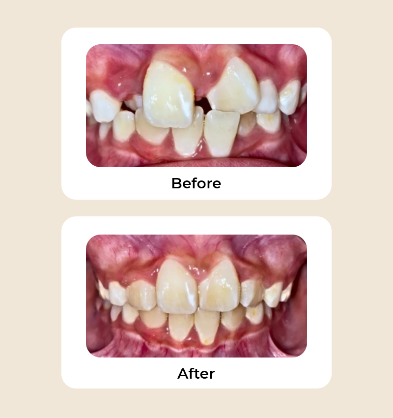 before-after-crowding