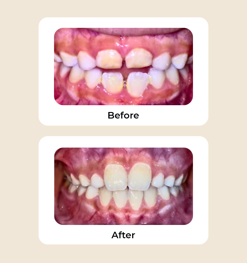 before-after-openbite