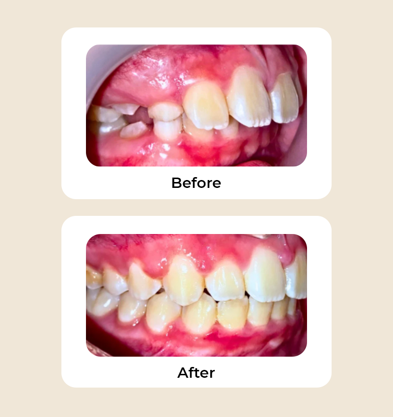 before-after-overjet